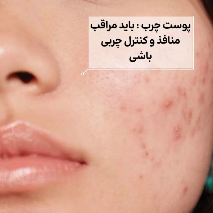 مراقبت از پوست چرب
